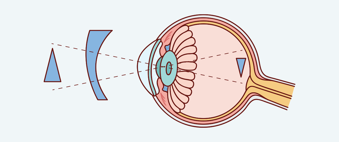 Does Astigmatism Get Worse Over Time?
