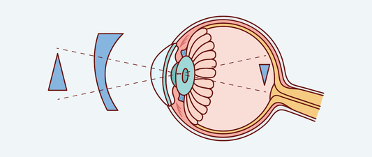 Does Astigmatism Get Worse Over Time?