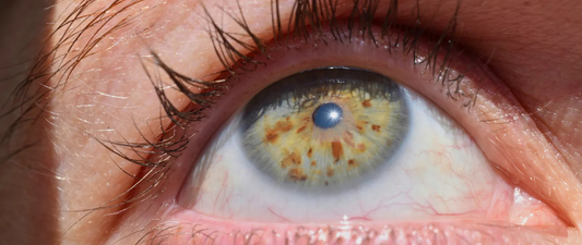 What Is an Eye Freckle?